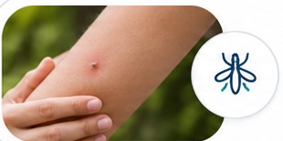 Insect bite on a forearm outdoors